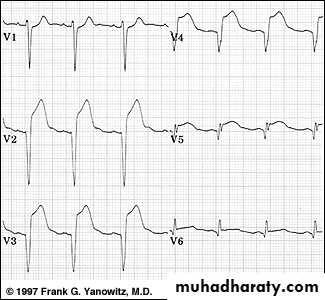 2 THE 12 LEADS STNDARD ECG docx - د. اروى - Muhadharaty