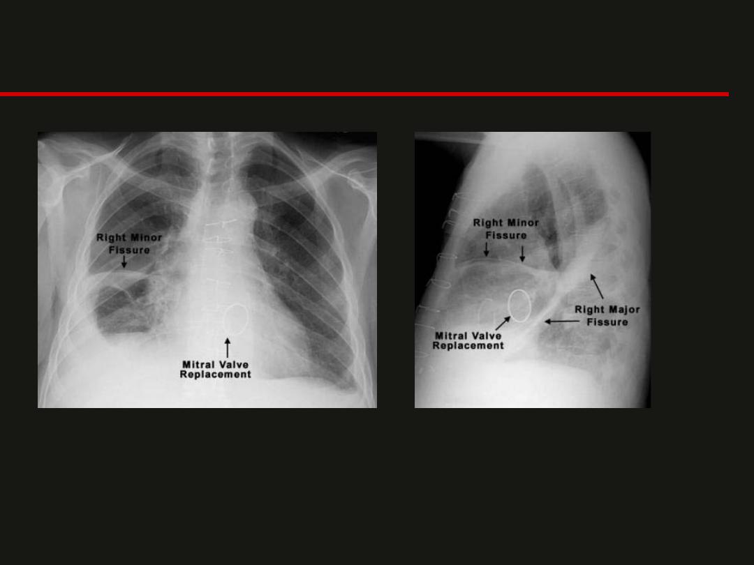 Interpretation of chest CT and X ray pdf - عملي - Muhadharaty