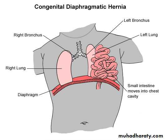 Hernia 3 docx - نظري - Muhadharaty