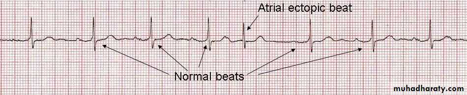 arrhythmia-disorders-of-heart-rate-and-rhythm-and-conduction-pptx