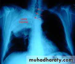 Tumours of the bronchus and lung pptx - Respiratory - Muhadharaty