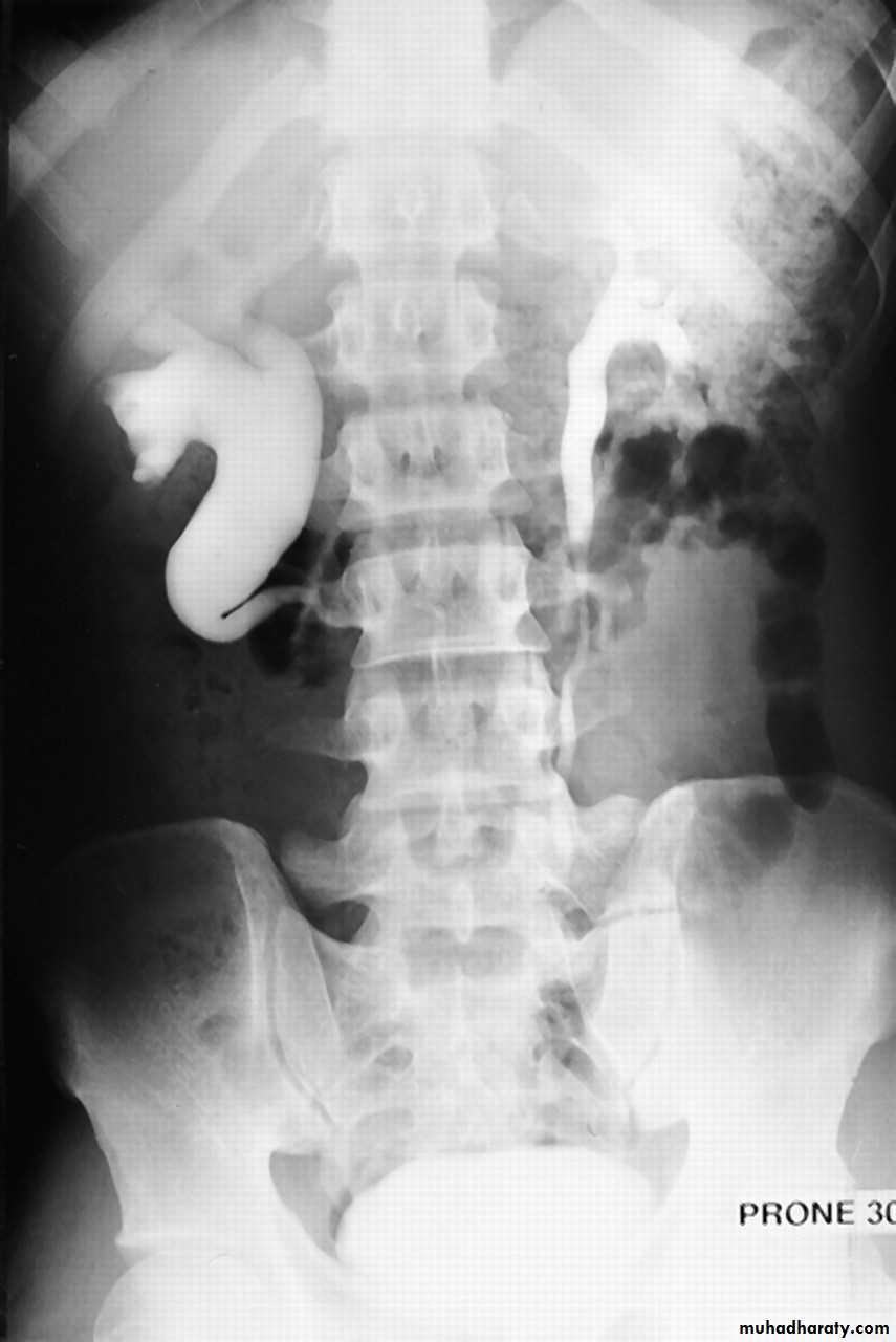 Congenital anomalies of renal tract pptx - د.زهراء - Muhadharaty