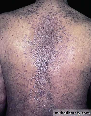 Psoriasis and other Papulosquamous Diseases pptx - د.عمر - Muhadharaty