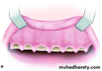 Preprosthetic Surgery Pptx - Dr.Wafaa - Muhadharaty