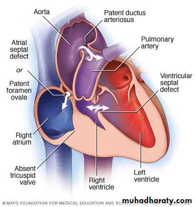 Cyanotic Congenital Heart Disease docx - د.خليل - Muhadharaty