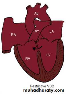 VENTRICULAR SEPTAL DEFECT docx - د.خليل - Muhadharaty