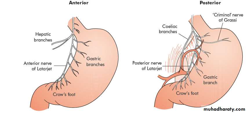 polya gastrectomy