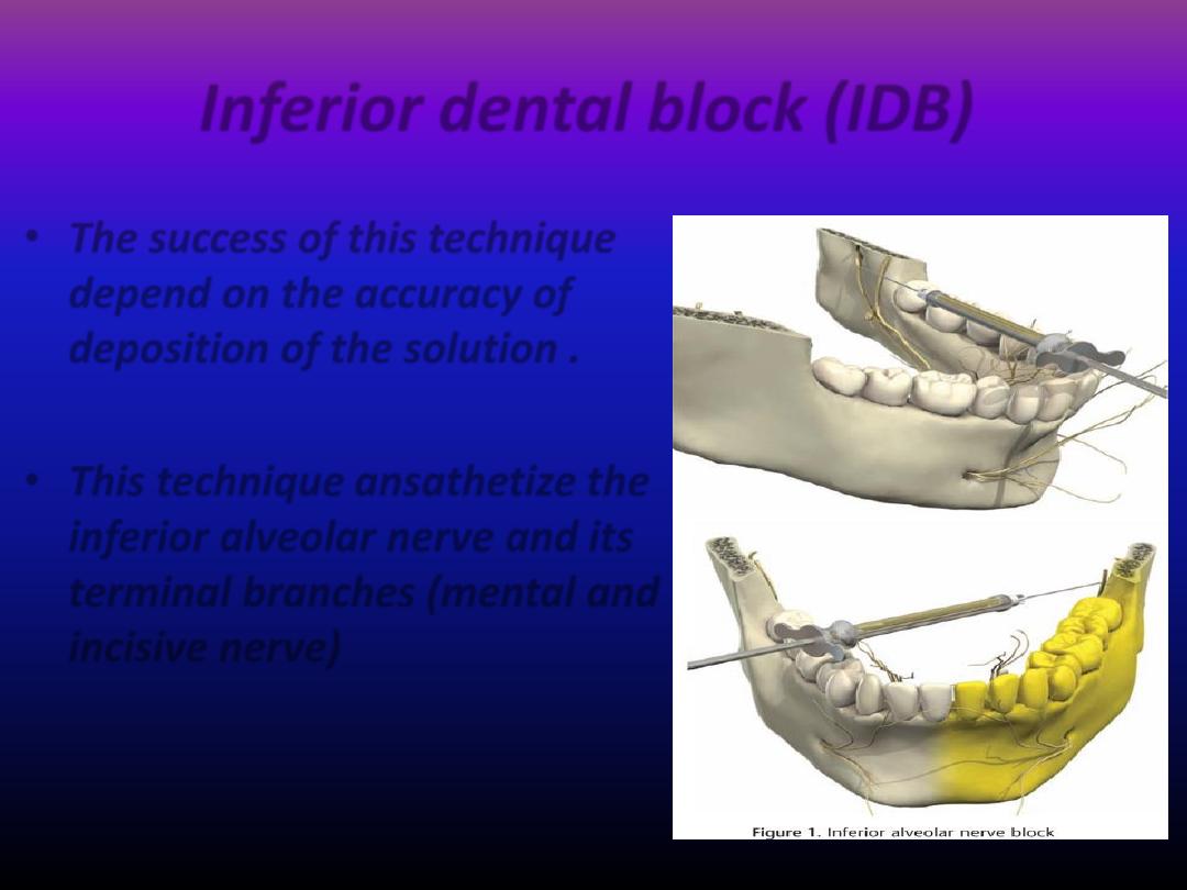 Techniques for local anasthesia in dentistry pdf - د.محمد رحيل ...