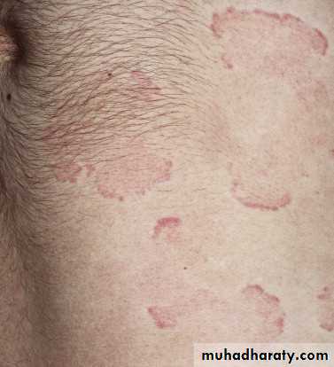 Urticaria pptx - د.منار - Muhadharaty