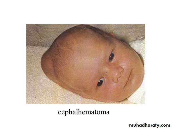 BIRTH INJURIES docx - د.بسام - Muhadharaty