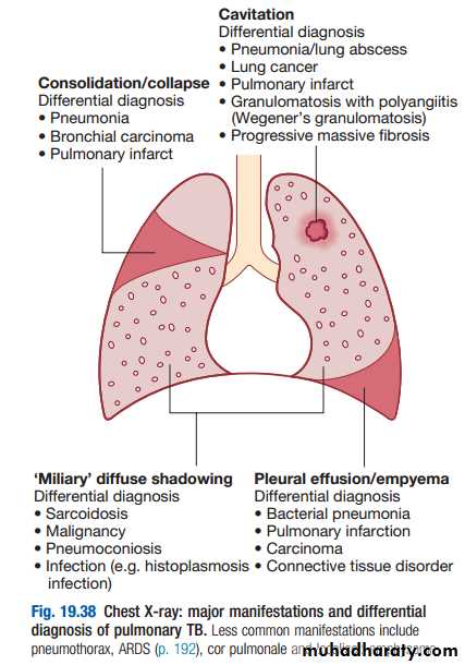 Tuberculosis pptx - د. زيدان - Muhadharaty