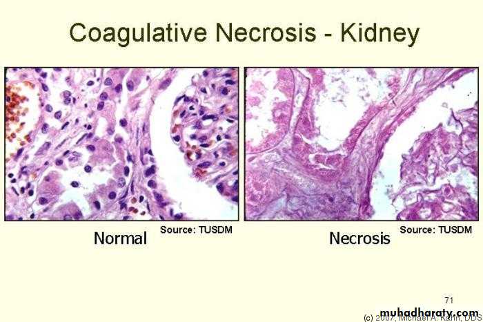 coagulative necrosis kidney
