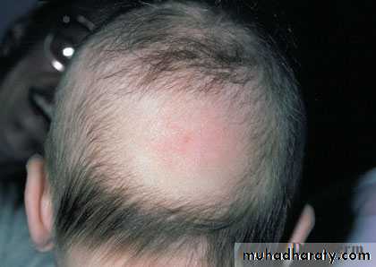 Alopecia pptx - د.منار - Muhadharaty