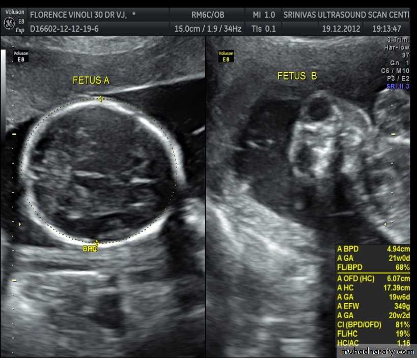 Ultrasound in Obestatric docx - د.زهراء - Muhadharaty