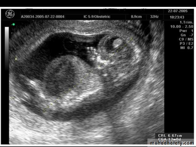 Ultrasound in Obestatric pptx - د.زهراء - Muhadharaty