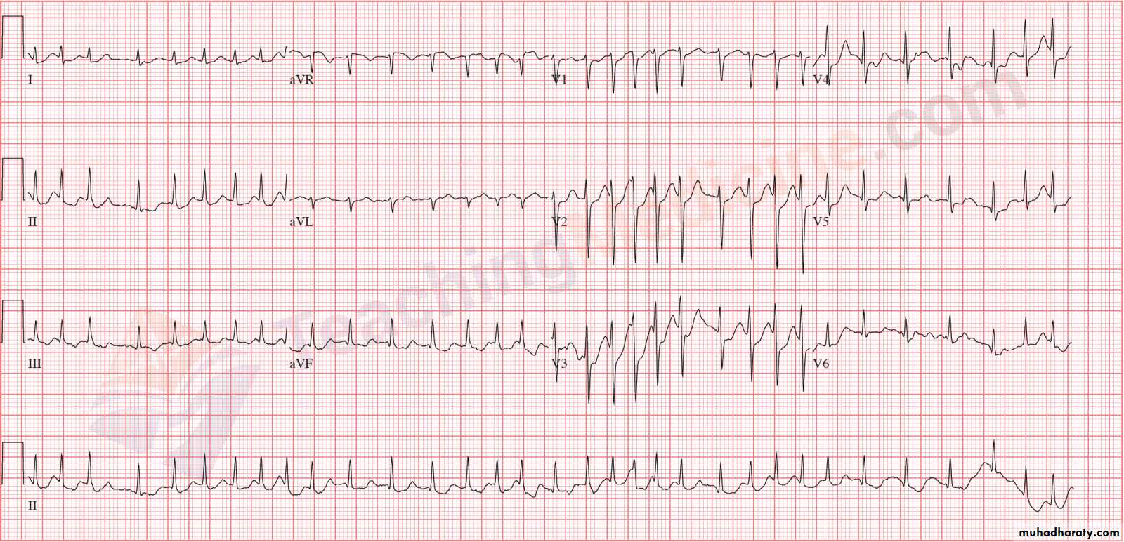 Ecg Pptx - عملي - Muhadharaty