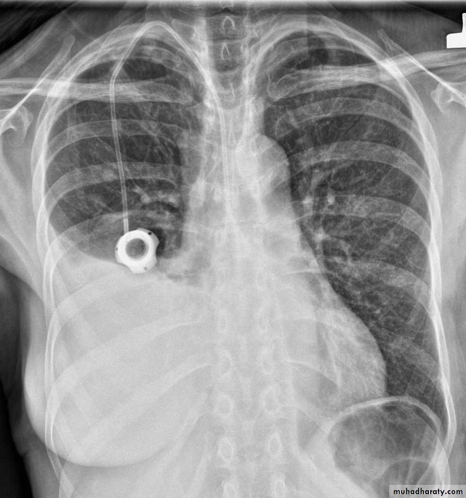 Рентген снимок грудной клетки