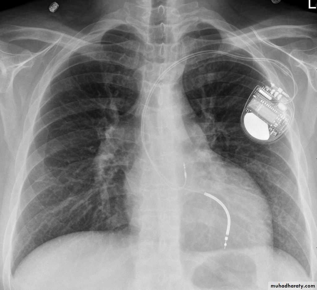 Chest surgery pptx - طلاب كروب B - Muhadharaty