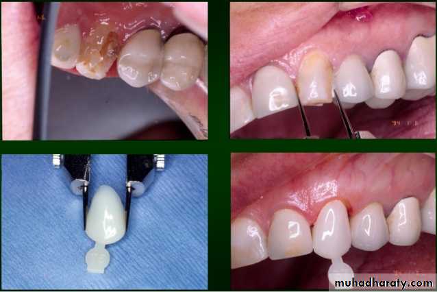 Provisional Restoration Pptx - Dr. Manaf - Muhadharaty