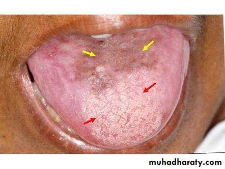 Benign Tongue Lesions