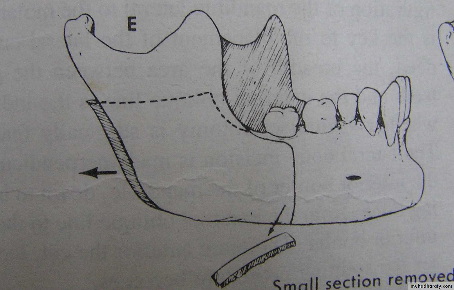 Orthognathic Surgery Pptx - Dr. Alaa - Muhadharaty