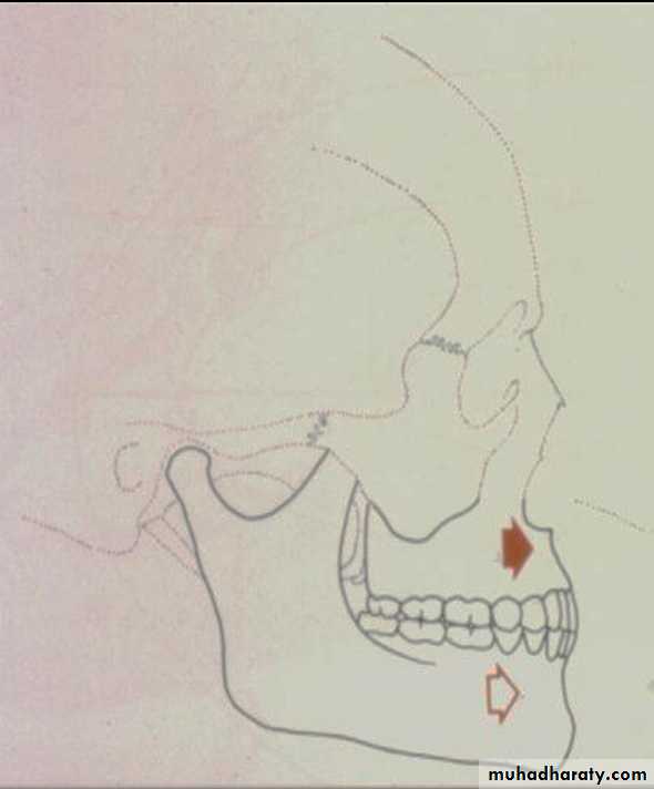 Orthognathic Surgery Pptx - Dr. Alaa - Muhadharaty