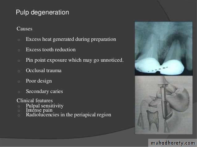 failure in crown and bridge pptx - Dr. Manaf - Muhadharaty