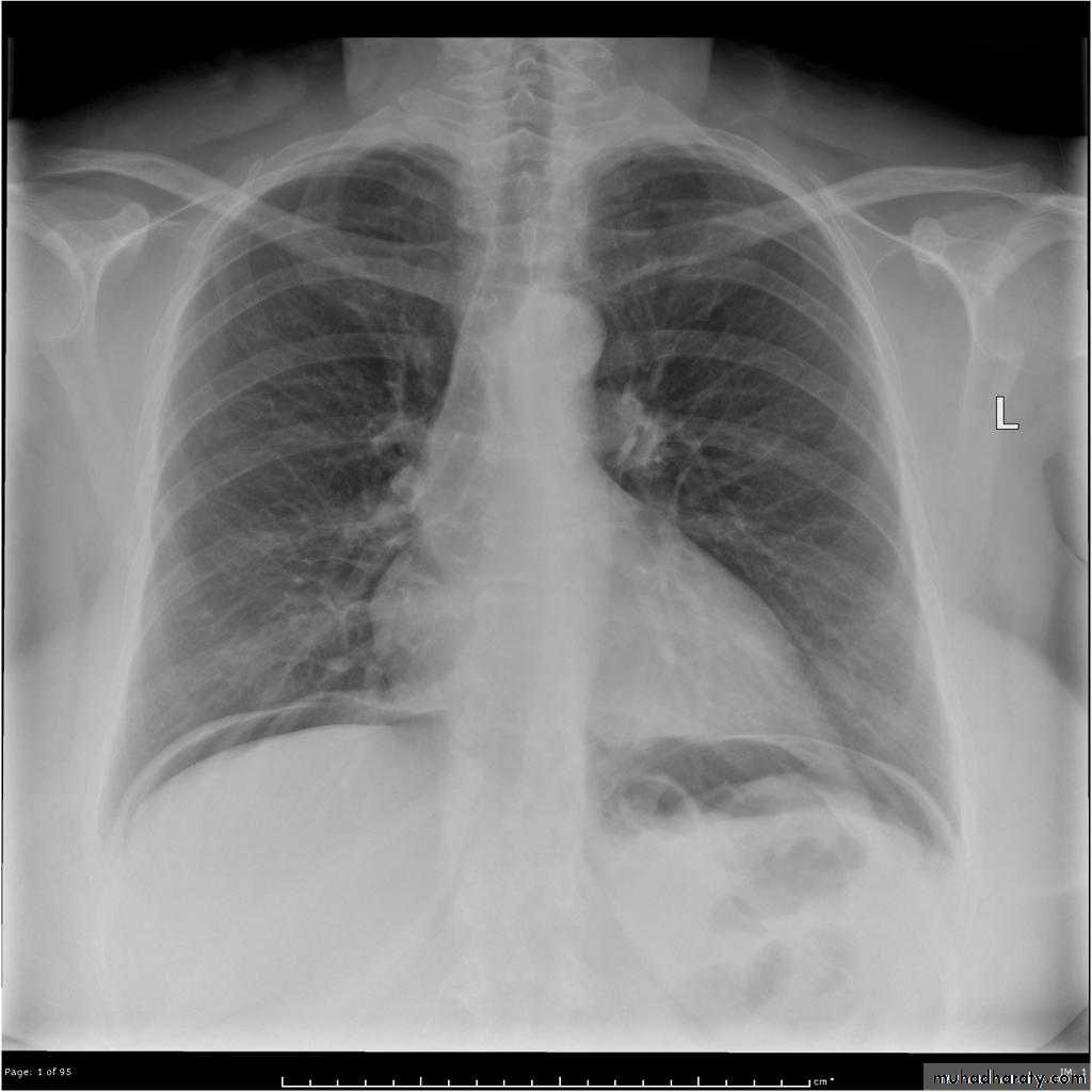 imaging of acute abdomen pptx - د. عبد اللطيف البياتي - Muhadharaty