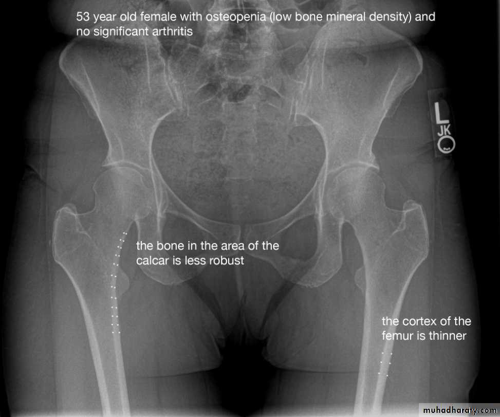 Остеопороз снимок тазобедренной кости