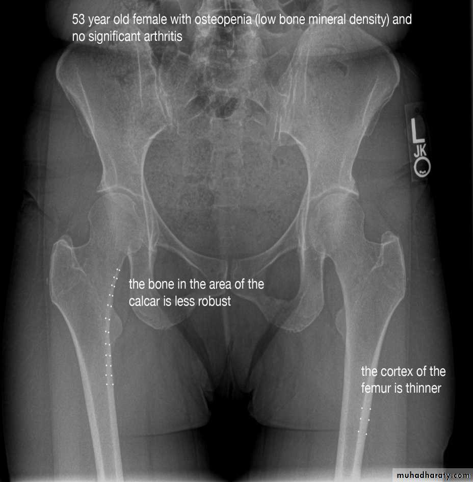 bone diseases 1 ppt pptx - د. نجلاء حنون - Muhadharaty