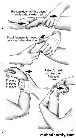 Colles Fracture Reduction and Plaster Technique 