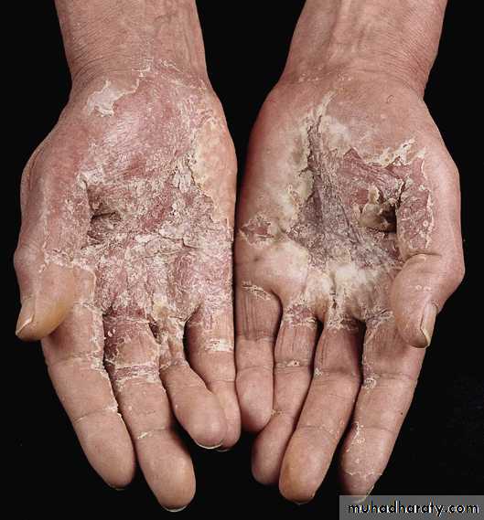 Irritant Contact Dermatitis Hands