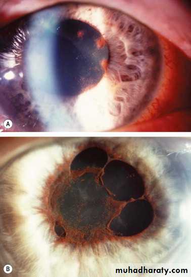 uveitis ppt pptx - د.عمر - Muhadharaty