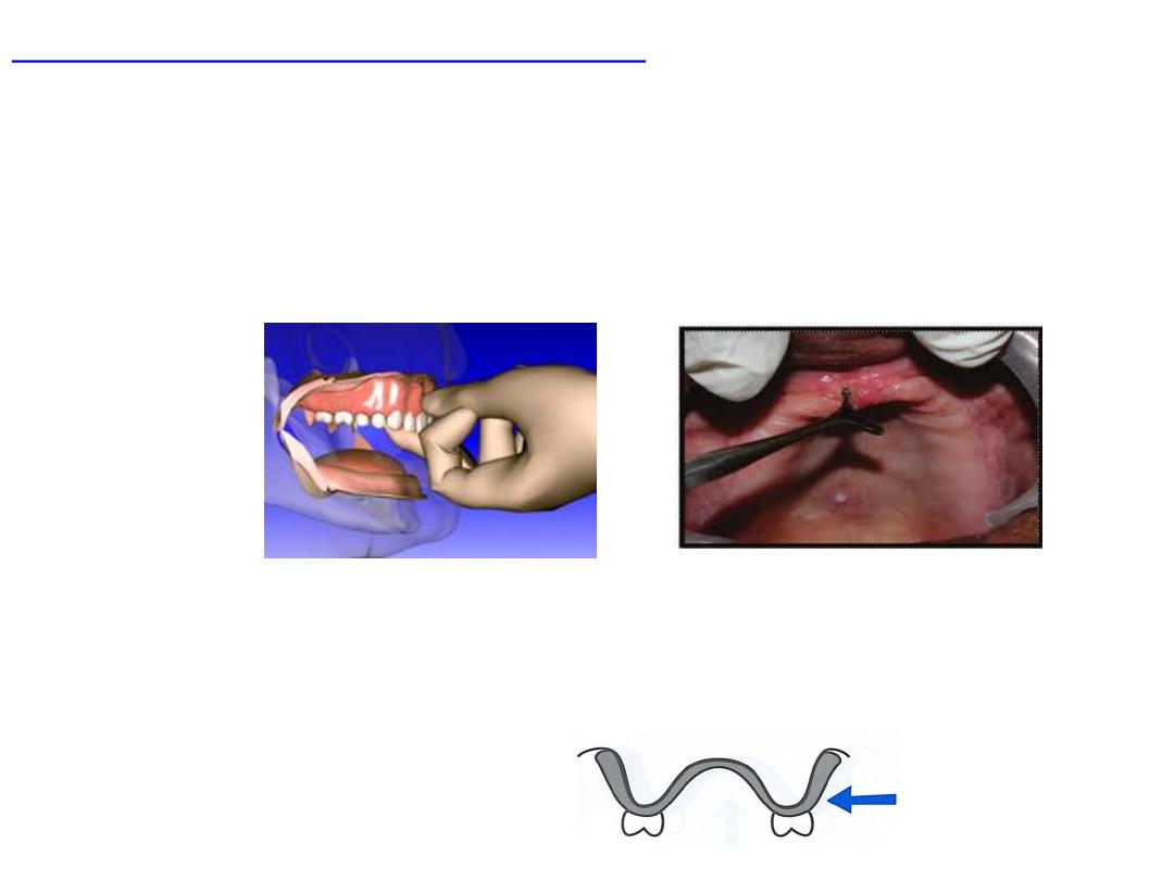 retromylohyoid space