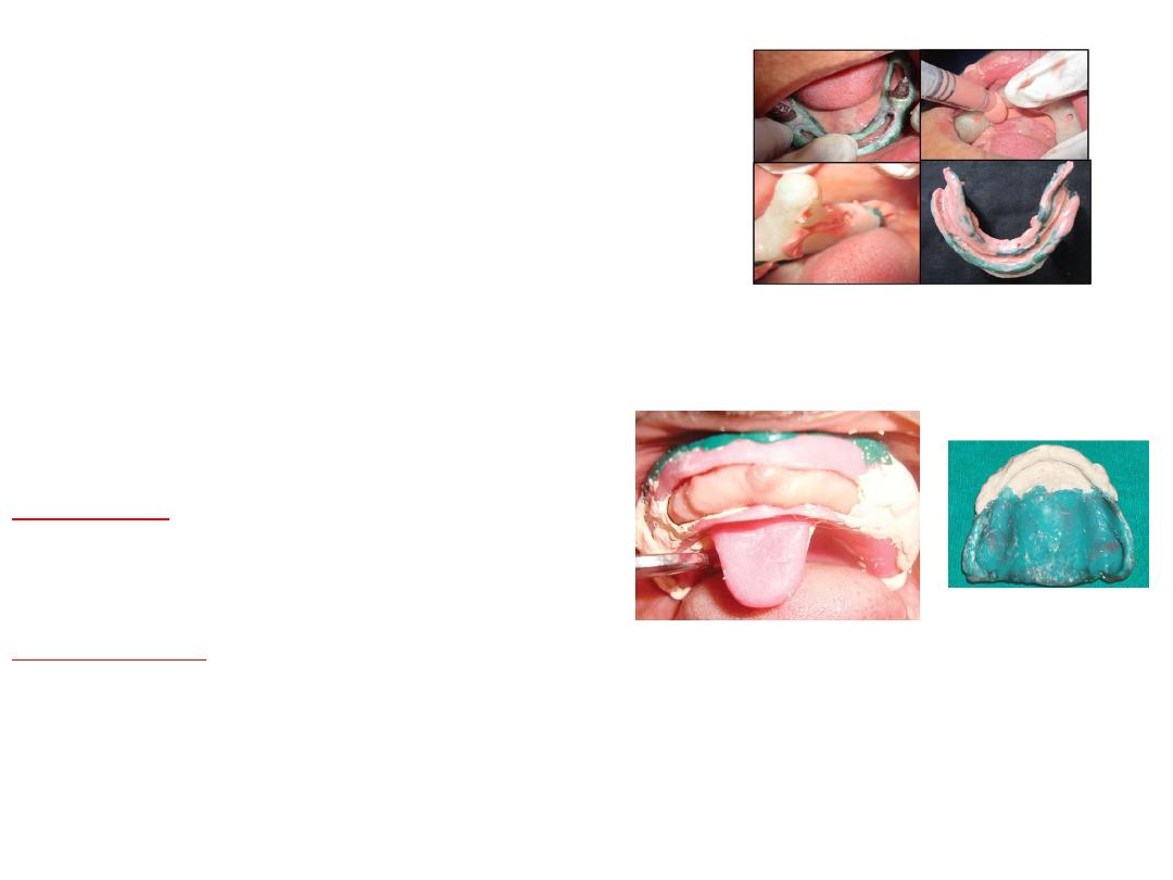 retromylohyoid space