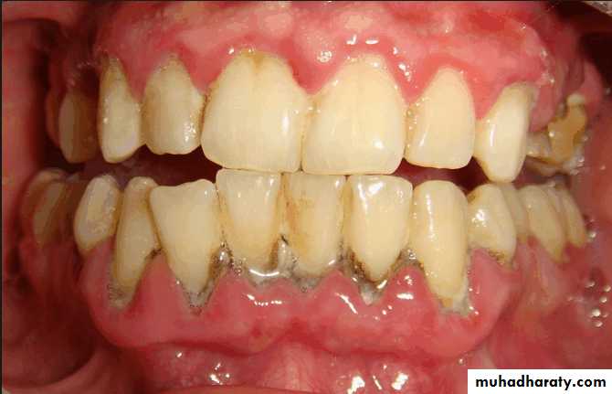 diagnosis and treatment plane for RPD-part 2 pptx - د.رضوان - Muhadharaty