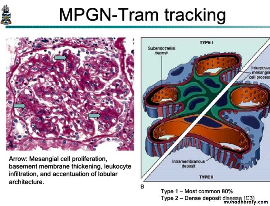 membranoproliferative glomerulonephritis tram track