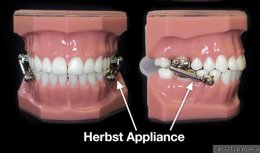 Class II Appliances  Five Star Orthodontic