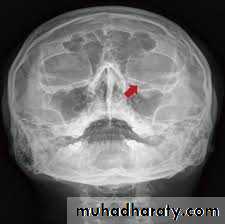 midfacial injury powerpoint pptx - د.نجاة - Muhadharaty