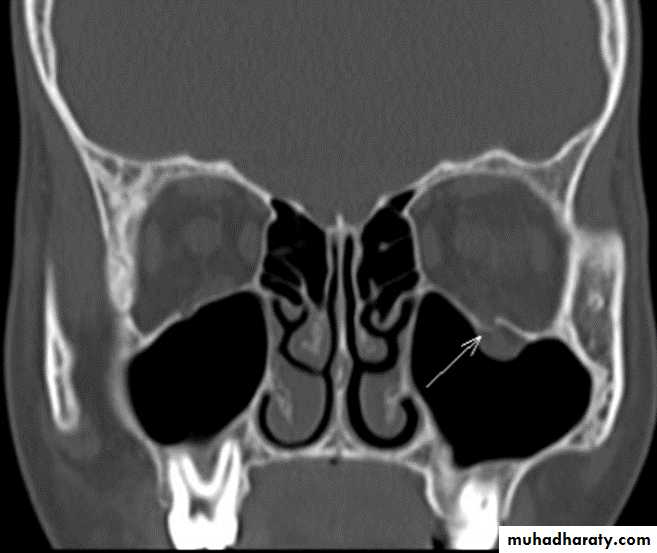 midfacial injury powerpoint pptx - د.نجاة - Muhadharaty