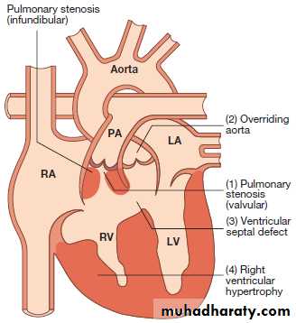 congenital heart disease and infective endocarditis pptx - شكري ...