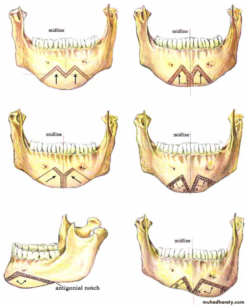 Orthognathic Surgery Pptx - د.نجاة - Muhadharaty