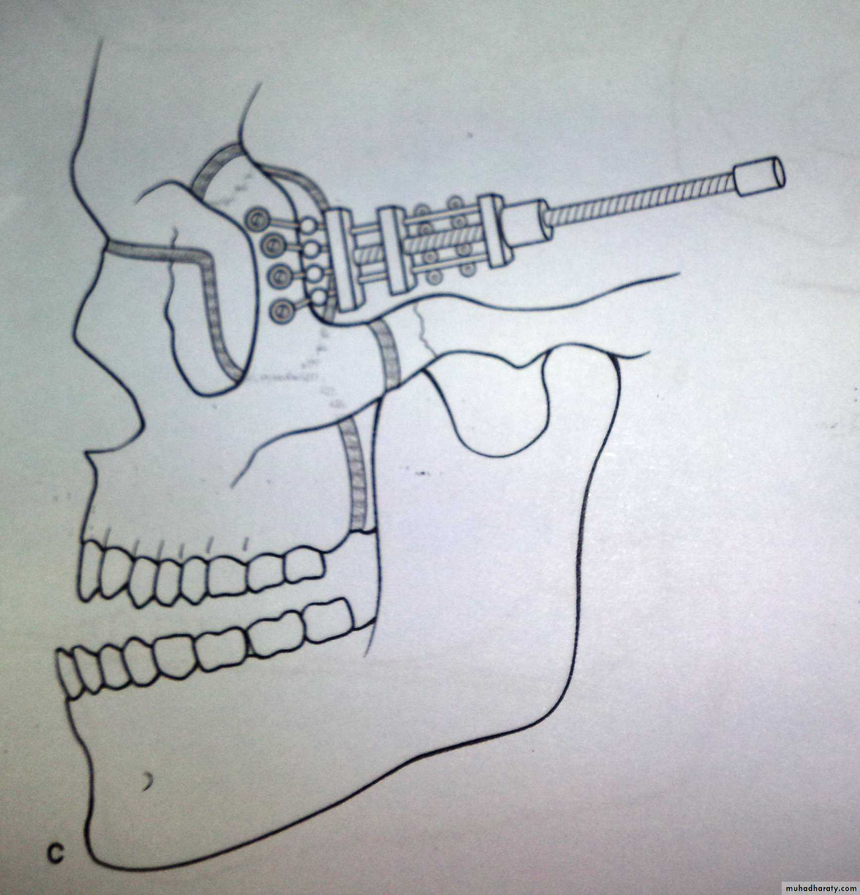 Orthognathic Surgery Pptx - د.نجاة - Muhadharaty