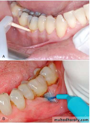 furcation involvement pptx - د.هندرين - Muhadharaty