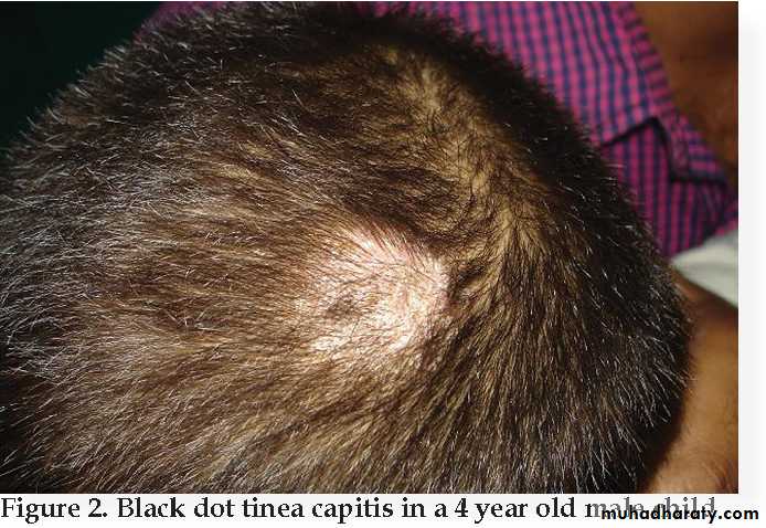 غيداء طلال بصفر🇸🇦 on X: ♦️Clinical findings:it's Causes dermatophytosis  1-Tinea capitis:infection in scalp👨🏼‍🦲and hair💇🏻‍♀️ 2-Tinea barbae:infection  in beard area🧔🏻 3-Tinea corporis:infection in the trunk🤽🏻‍♂️ 4-Tinea  cruris(jock itch