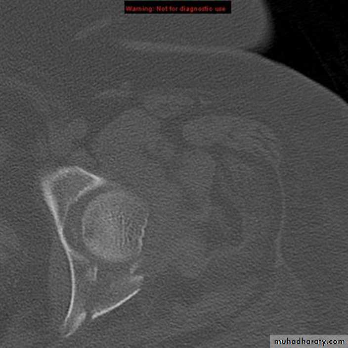 Lower Limb Fractures Pptx - د. مثنى - Muhadharaty