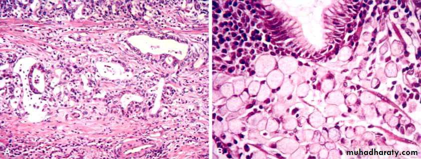 Hypertrophic Gastropathies pptx - D. Maha - Muhadharaty