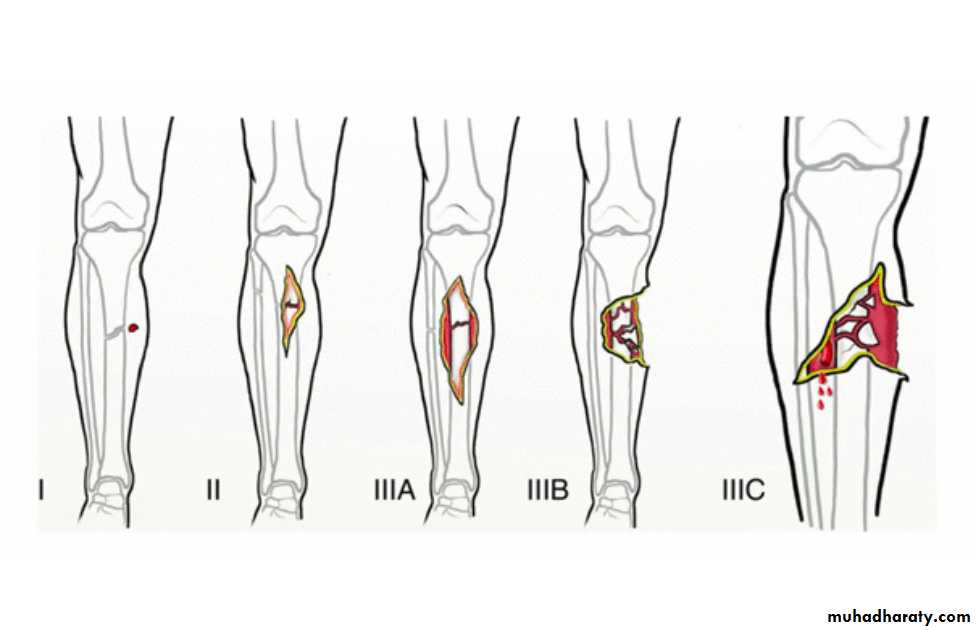 General Principles Of Fractures Pptx - D. Haider - Muhadharaty