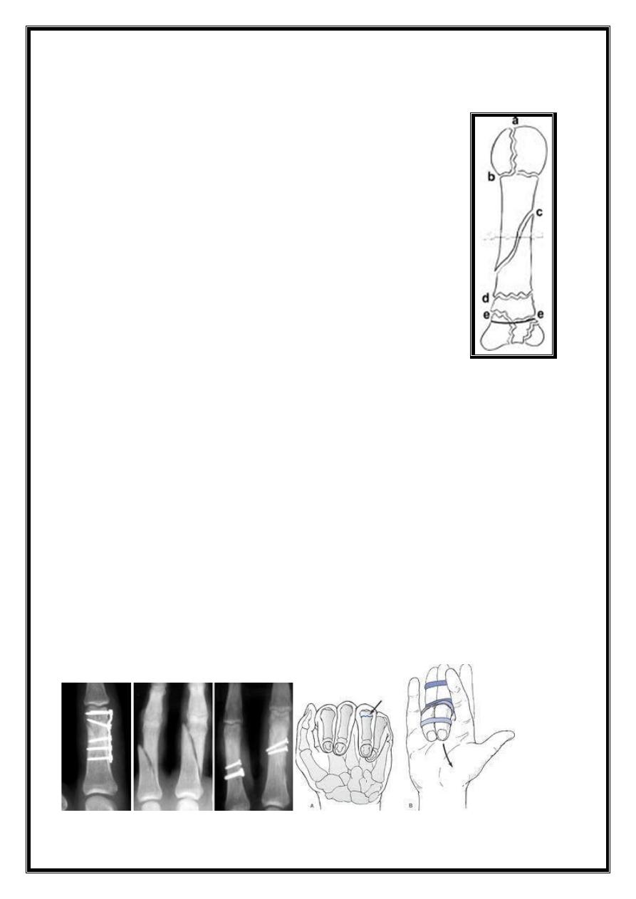 Metacarpal & Phalangeal Fractures Pdf - D. Khalid - Muhadharaty