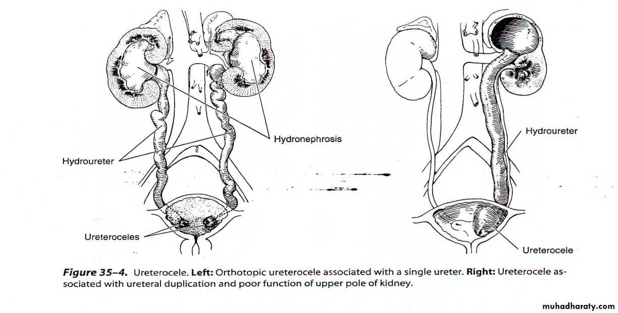 Duplication Of Ureter Docx D Mazin Muhadharaty